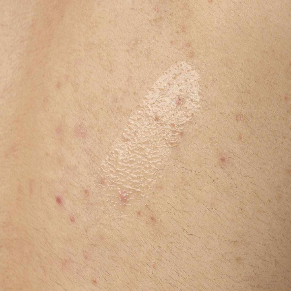 salicylic-acid-0-5-body-serum-r0 ORD-salicylic-acid-05-body-240ml-application.jpg
