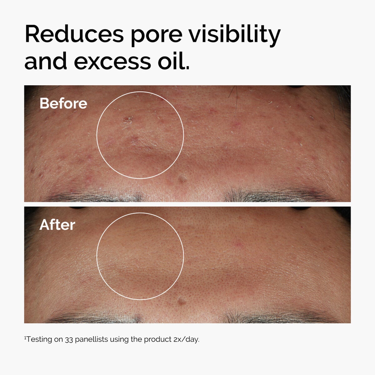 niacinamide-10-zinc-1-q3 ord-niacinamide-zinc-blemish-serum-before-after-pores.jpg