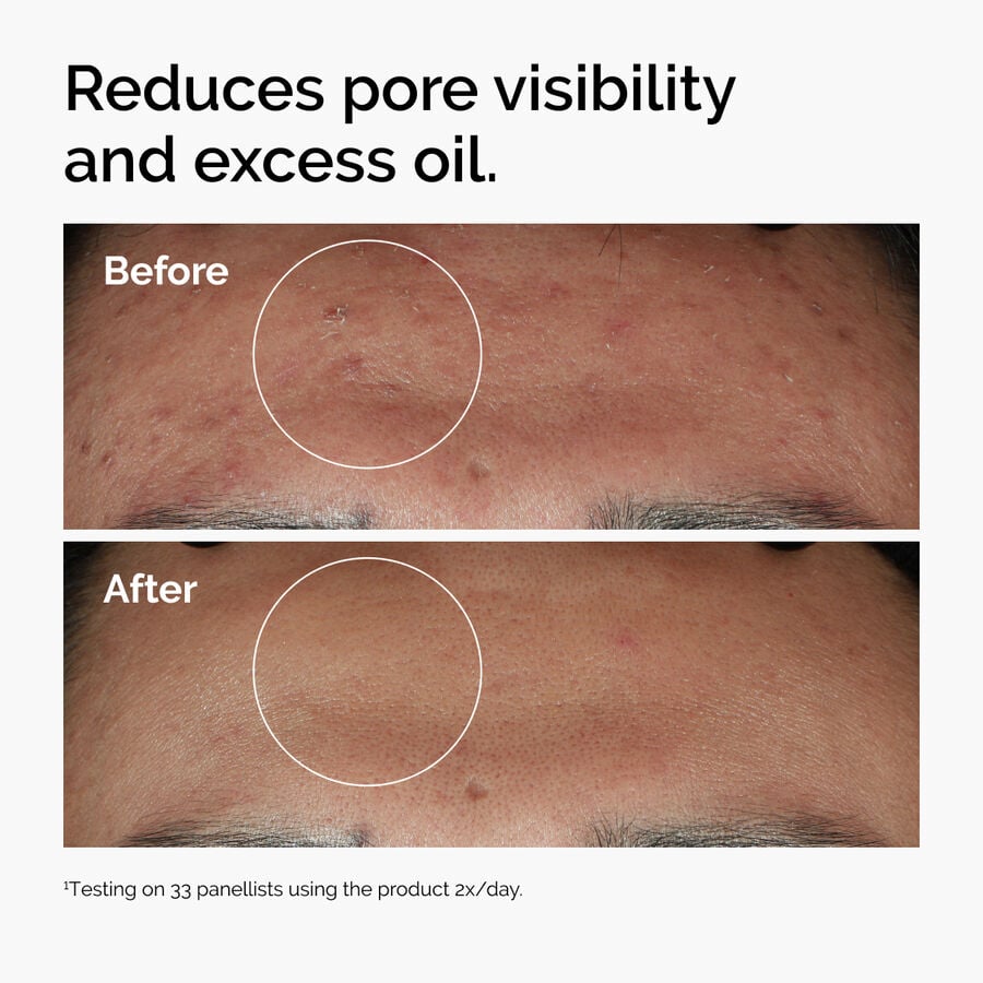 niacinamide-10-zinc-1-q3 ord-niacinamide-zinc-blemish-serum-before-after-pores.jpg