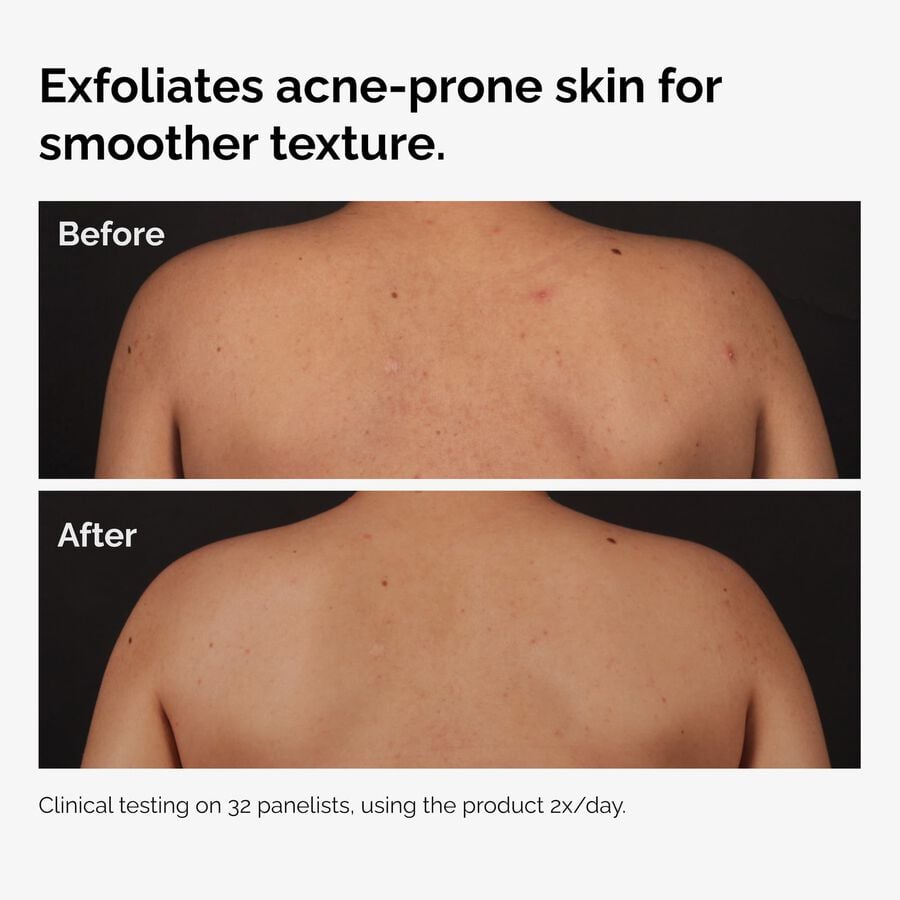 the-body-care-collection-z9 ord-salicylic-acid-body-serum-before-after-graphic-NA.jpg